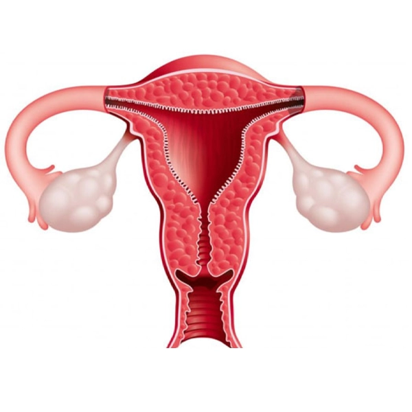 علائم چسبندگی رحم