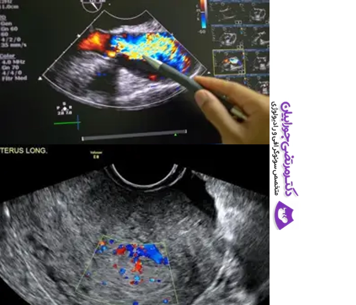 سونوگرافی رنگی