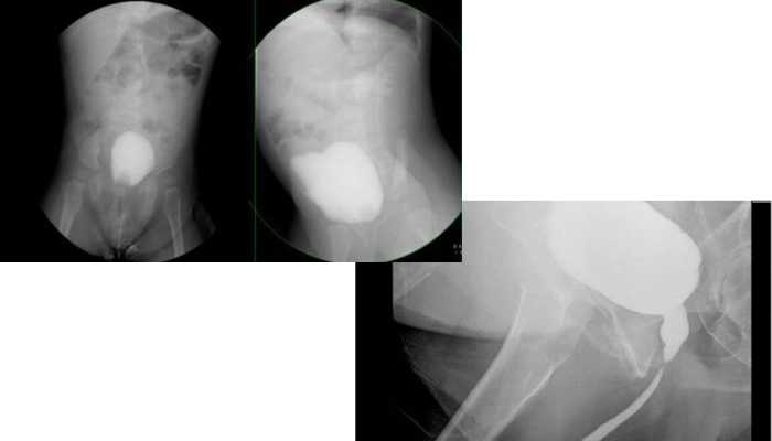 VCUG چگونه انجام میشود؟