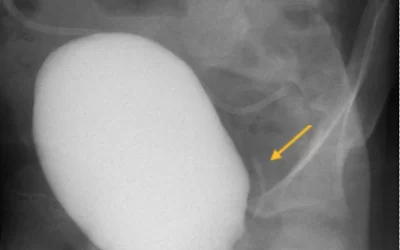 vcug (وی سی یو جی) چیست – VCUG چگونه انجام میشود؟